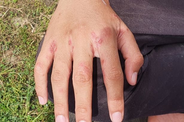 Scabies Outbreak Forces Hospital Ward Closures Across UK